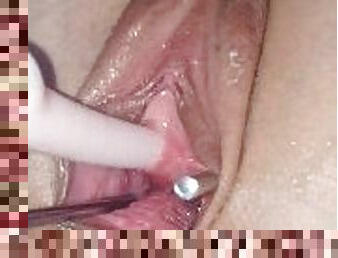 Dilator Peehole play